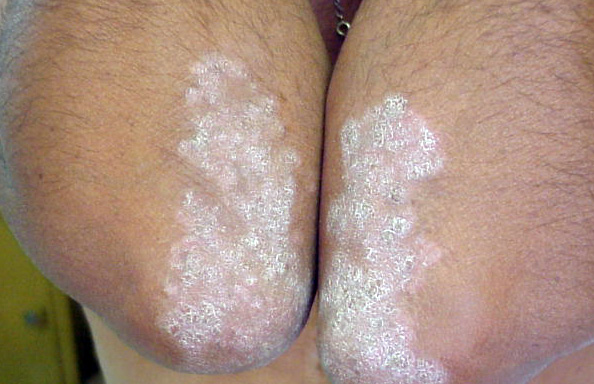 Psoriasis